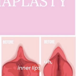 Labiaplasty is about more than appearance. 🤍

For many women, it’s about feeling comfortable, confi