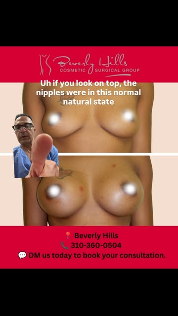 Breat Augmentation before and after
