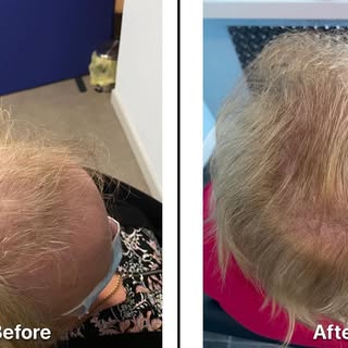 Female Pattern Hair Loss