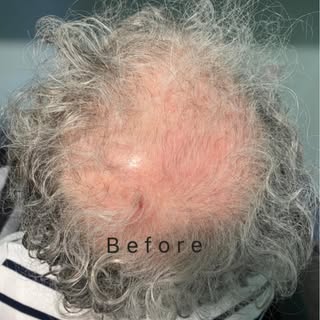 Trichological Treatment