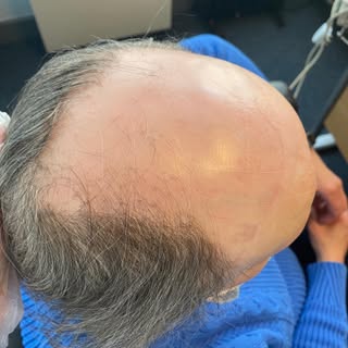 Common Hair Loss and Scalp Disorders