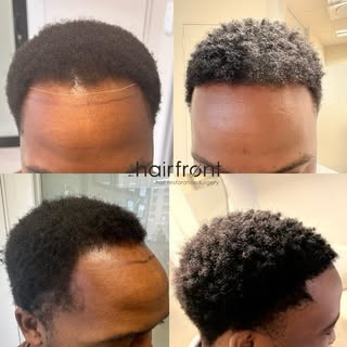 ✨ 1 Year Afro FUE Hair Transplant Result 1000 Grafts Implanted ✨

A natural hairline. Improved densi