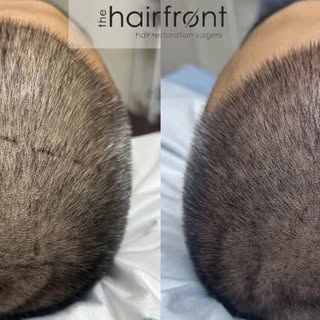 ✨ SMP After Just 1 Session ✨

Scalp Micropigmentation (SMP) is a process that is built in layers to 