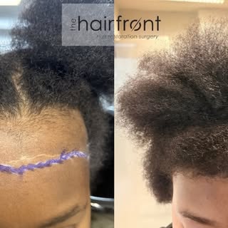 ✨ From Receding Hairline to Radiating Confidence! ✨🤩

The results speak for themselves... and this 