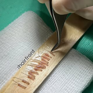 Every graft counts✨

Behind every successful hair transplant is precision, patience, and years of ex