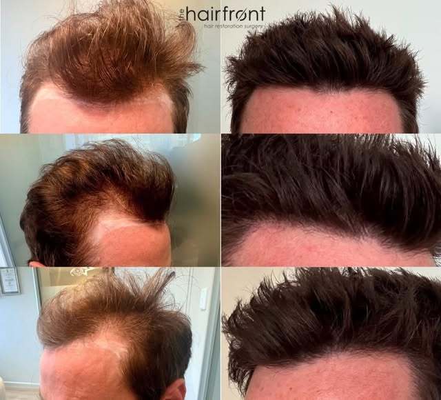 Natural-looking hairlines aren’t perfectly straight and that’s exactly what makes them look natural.