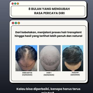 Hair transplant bukan memberikan rambut palsu, melainkan memindahkan folikel rambut sendiri ke area 