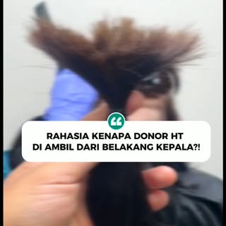 Kenapa rambut donor selalu diambil dari belakang kepala? 🤔

Bukan tanpa alasan. Rambut di area bela