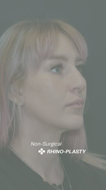 Refinement without surgery.

In this transformation, Deanne Pilsner, RN, corrected the appearance of