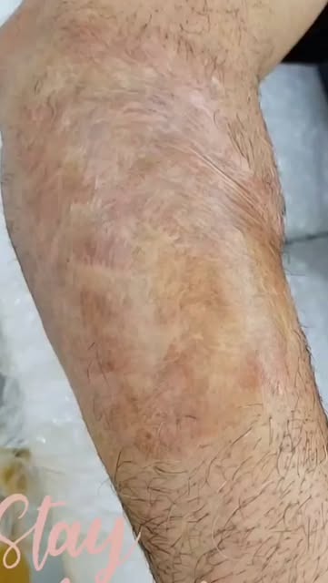 🔥 Burn Mark Resolution by India’s First Camouflage Artist

A burn mark can leave more than a scar o