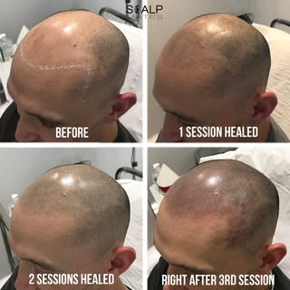 http://scalpmates.co.uk Transforming lives, one session at a time! 🌟 Witness the incredible result 