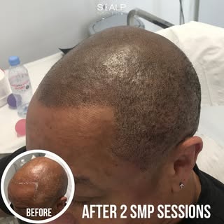 http://scalpmates.co.uk 
Meet our incredible friend who's rocking his new look with confidence! 🙌✨ 