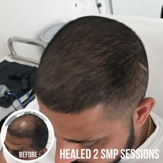 http://ScalpMates.co.uk

Meet our Manchester buddy! His density SMP treatment? Simply incredible! Fr
