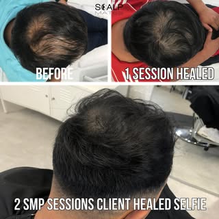 ScalpMates.co.uk

The remarkable results of scalp micropigmentation (SMP) treatment at ScalpMates. T