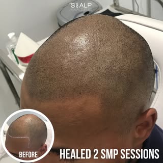 ScalpMates.co.uk

Going for a fairly soft, natural hairline. Two sessions of SMP resulted in a flawl