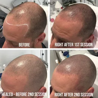 🔥 TRAINING AVAILABLE 🔥 #scalpmicropigmentation giving you follicle realness 👌🏻 Who is gonna know