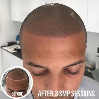 Spicing things up with a sharp hairline

#scalpmates #BaldLook, #ShavedHeadHair, #CleanShaven, #Bald