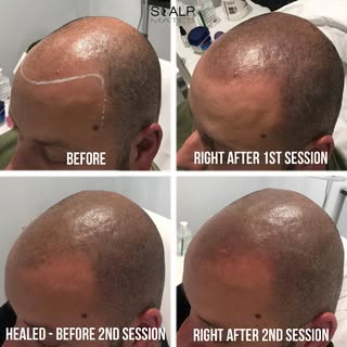 2 session process of SMP / hairline cosmetic tattoo. 

#scalpmates 
#ScalpMicropigmentation
#HairTat