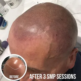 🔥 Scalp Micro-Pigmentation 🔥 Fire results and what and Age changer 😍 most importantly clients con