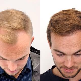 A successful hair transplant is about more than restoring hair—it’s about achieving results that loo