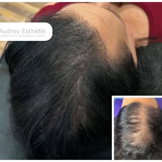 Résultat en micropigmentation capillaire 💛

Cette cliente est venue me consulter afin de camoufler 