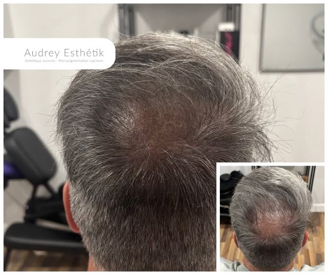 Résultats en micropigmentation capillaire 💛

Ce client est venu me voir il y a quelque temps pour d