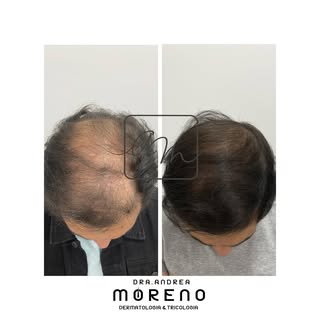 ¿Tiene de caída de cabello? Tenemos varias opciones de tratamiento para Ud.  según su caso, consúlte