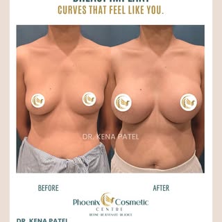Breast implant results like this aren’t about size, they’re about proportion, balance, and confidenc