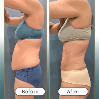 From stretched… to sculpted. 
This isn’t just a tummy tuck — it’s precision body contouring.

At Pho