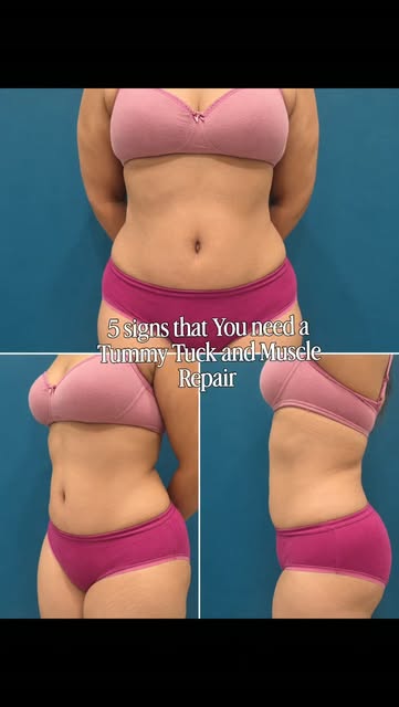 5 signs you may need a tummy tuck with muscle repair 👇🏼

Not every tummy needs more dieting or mor