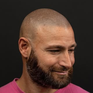 Scalp Micropigmentation showed with different lights 

This client very tanned had really hard skin 