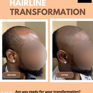 If you are looking for a long-term enhancement for your head or hairline...CD Elite SMP is for you!
