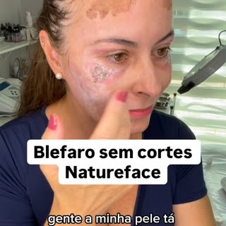 Meu processo de cicatrização do procedimento Blefaro sem cortes Natureface. #natureface #blefaro #bl