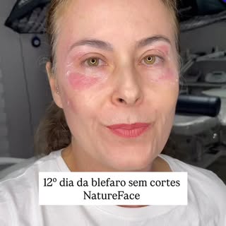 Décimo segundo dia de recuperação. #campinas #blefarosemcortes #natureface