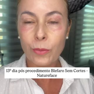 13º dia pós procedimento Blefaro Sem Cortes - Natureface. #Natureface #blefarosemcortes #campinas