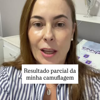 Vídeo atrasado em uma semana do@meu resultado de camuflagem de manchas brancas e tratamento com jato