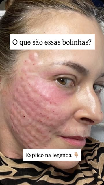 As “bolinhas” que todo mundo me pergunta tem um motivo: estimular a pele a trabalhar melhor.
O Proto