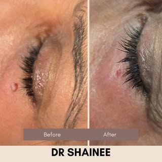 Quick procedure, minimal downtime.
At RenovaDerm—precision care, visible results. Healing reveal in 