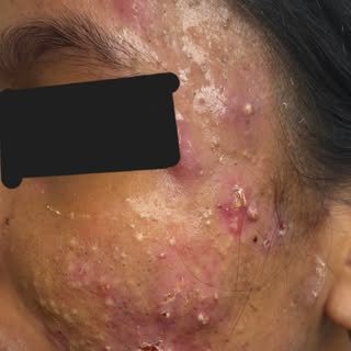 Acne transformation .....
For appointments - 9239072302
#acnetreatment #acneproblems #dermatologists