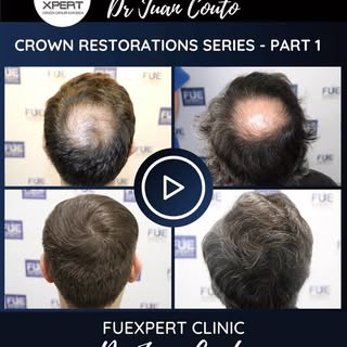🙇🏻‍♂️CROWN RESTORATION SERIES - PART 1 

🔹This is the FIRST PART of a series of CROWN RESTORATION