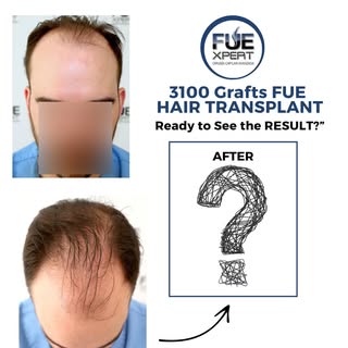 🔹3100 Grafts FUE Hair Transplant

Details of the FUE Hair Transplant:
Male – 36 years old 
Type of 