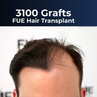 🔴 📹 VIDEO 3100 Grafts FUE Hair Transplant

Details of the FUE Hair Transplant:
Male – 36 years old