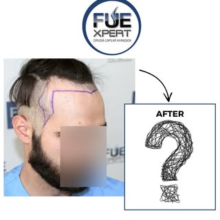 🔹2204 Grafts FUE Hair Transplant

Details of the FUE Hair Transplant:
27 year old man
Norwood Class