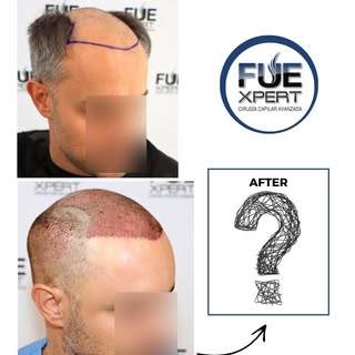 🔹3200 Grafts FUE Hair Transplant

Details of the FUE Hair Transplant:
37-year-old man
Norwood Class