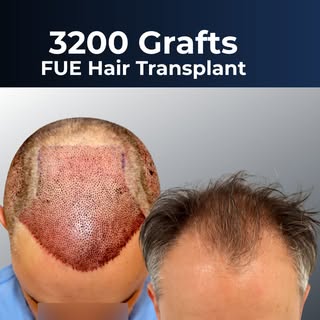 🎥 3200 Grafts FUE Hair Transplant 🔹

Details of the FUE Hair Transplant:
37-year-old man
Norwood C
