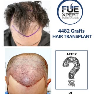 🔹 4482 Grafts FUE Hair Transplant

Details of the FUE Hair Transplant:
Patient –  43 year old man
T