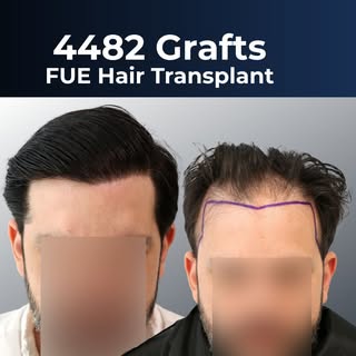 🎥 4482 Grafts FUE Hair Transplant

Details of the FUE Hair Transplant:
Patient –  43 year old man
T