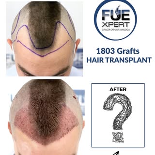 🔹1803 Grafts FUE Hair Transplant

Details of the FUE Hair Transplant:
Patient –  26 year old man
Ty