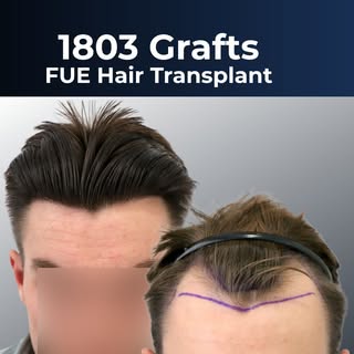 Video 🎥 1803 Grafts FUE Hair Transplant

Details of the FUE Hair Transplant:
Patient –  26 year old