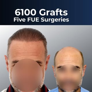 The ultimate test of a hair transplant is in its movement. 🎬👇

A photograph can show a lot, but to